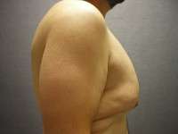 Male Belt Lipectomy