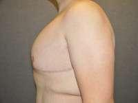 Male Belt Lipectomy