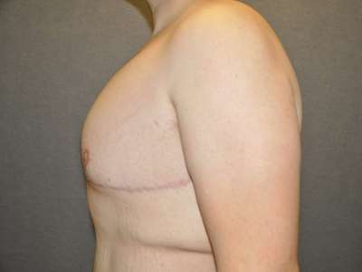 Male Belt Lipectomy