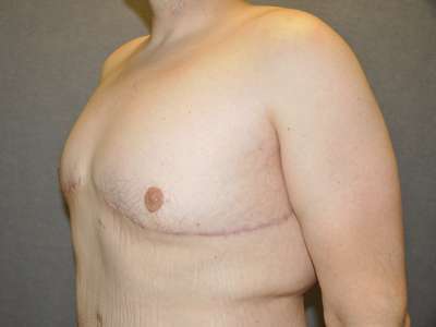 Male Belt Lipectomy