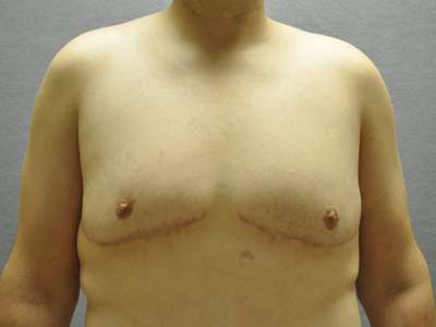 Male Belt Lipectomy Case 4662 After Photo Male Belt Lipectomy