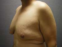 Male Belt Lipectomy
