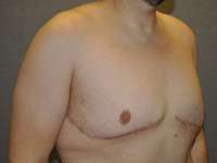 Belt Lipectomy