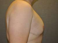 Male Belt Lipectomy