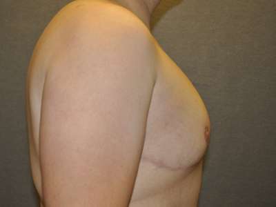 Male Belt Lipectomy