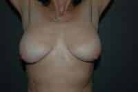 Breast Lift