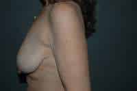 Breast Lift