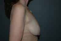 Breast Lift