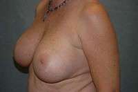 Breast Implant Removal