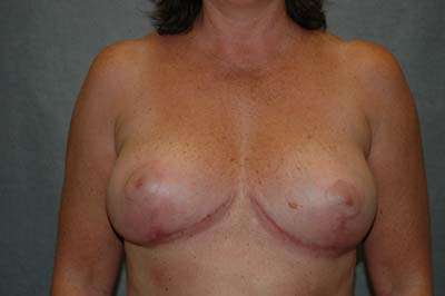 Breast Implant Removal