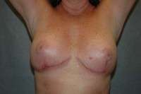 Breast Implant Removal