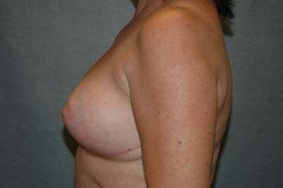 Breast Implant Removal