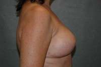 Breast Implant Removal