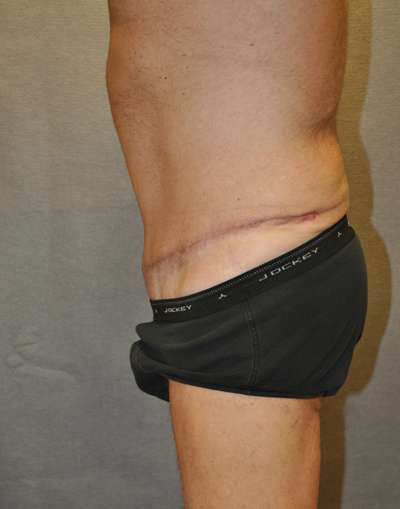 Abdominoplasty