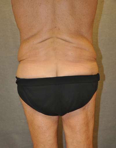 Abdominoplasty