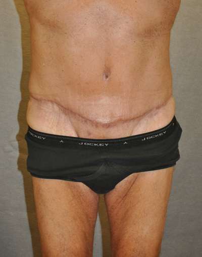 Abdominoplasty Case 5345 After Photo Abdominoplasty