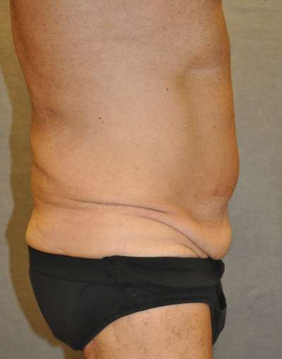 Abdominoplasty