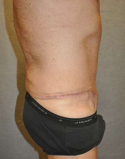 Abdominoplasty