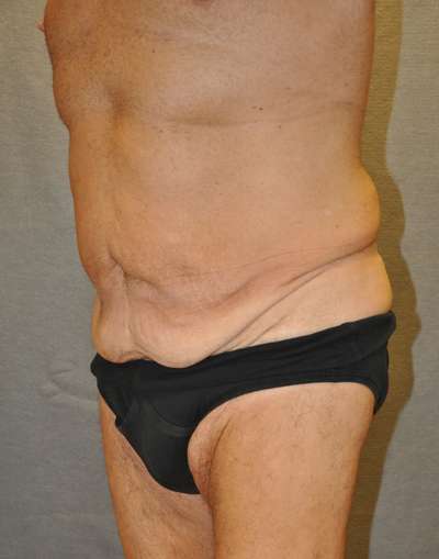 Abdominoplasty