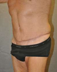 Abdominoplasty