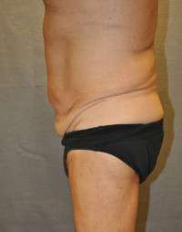 Abdominoplasty