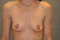 Breast Augmentation