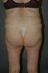 Liposuction