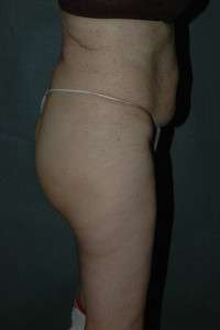 Liposuction