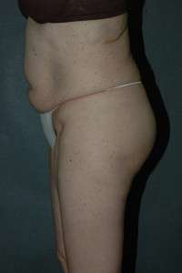 Liposuction