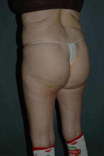 Liposuction