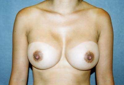 Breast Augmentation Case 5512 After Photo Breast Augmentation