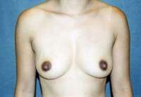 Breast Augmentation