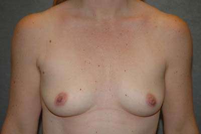 Breast Augmentation Case 5526 Before Photo Breast Augmentation