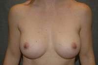 Breast Augmentation