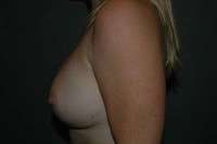 Breast Augmentation