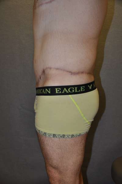 Male Belt Lipectomy
