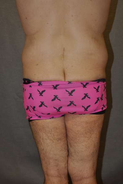 Male Belt Lipectomy