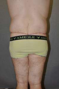 Male Belt Lipectomy