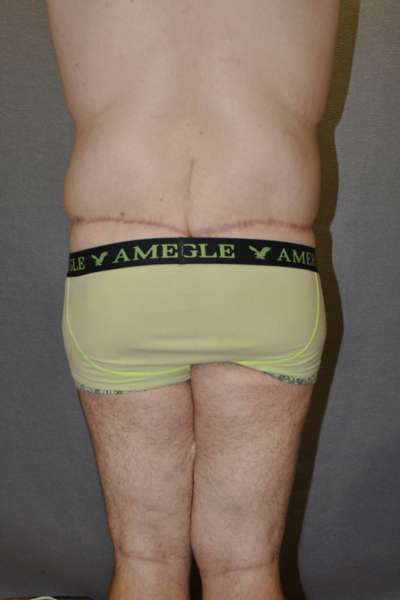 Male Belt Lipectomy