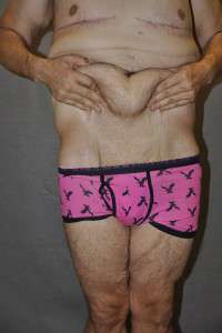 Male Belt Lipectomy