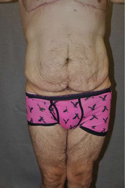 Male Belt Lipectomy