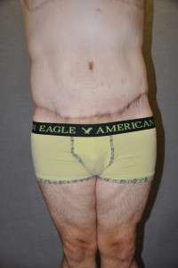 Male Belt Lipectomy