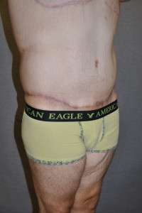 Male Belt Lipectomy