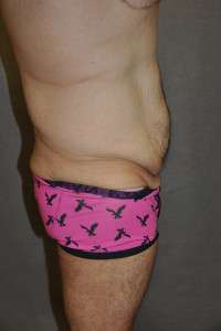 Male Belt Lipectomy