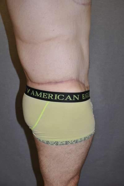 Male Belt Lipectomy