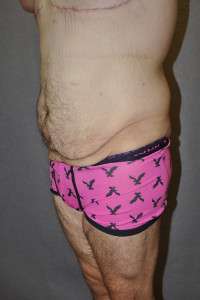 Male Belt Lipectomy
