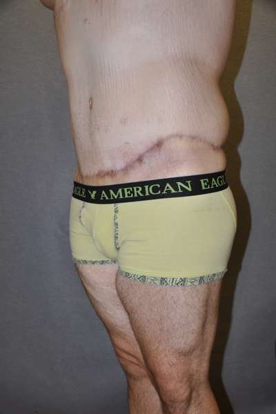 Male Belt Lipectomy