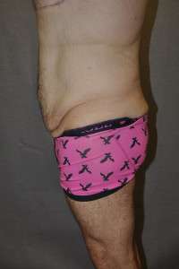 Male Belt Lipectomy