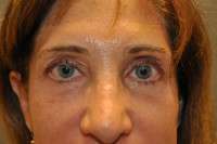 Eyelid Lift