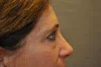 Eyelid Lift